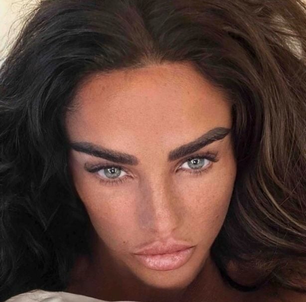 Katie Price has revealed that her trip to Thailand left her with a terrible sunburn and peeling skin on her face